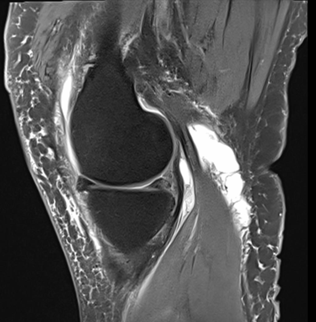 Wie Lange Dauert Es Bis Sich Eine Bakerzyste Zurückbildet Bakerzyste » Ordination Url | Orthopäde Dr. Robert Url in Graz