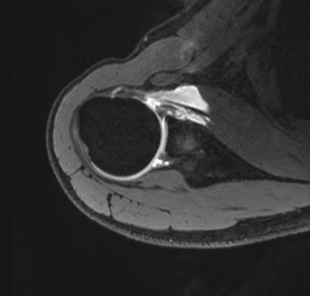 Schulterinstabilität Luxation, Subluxation » Ordination Url