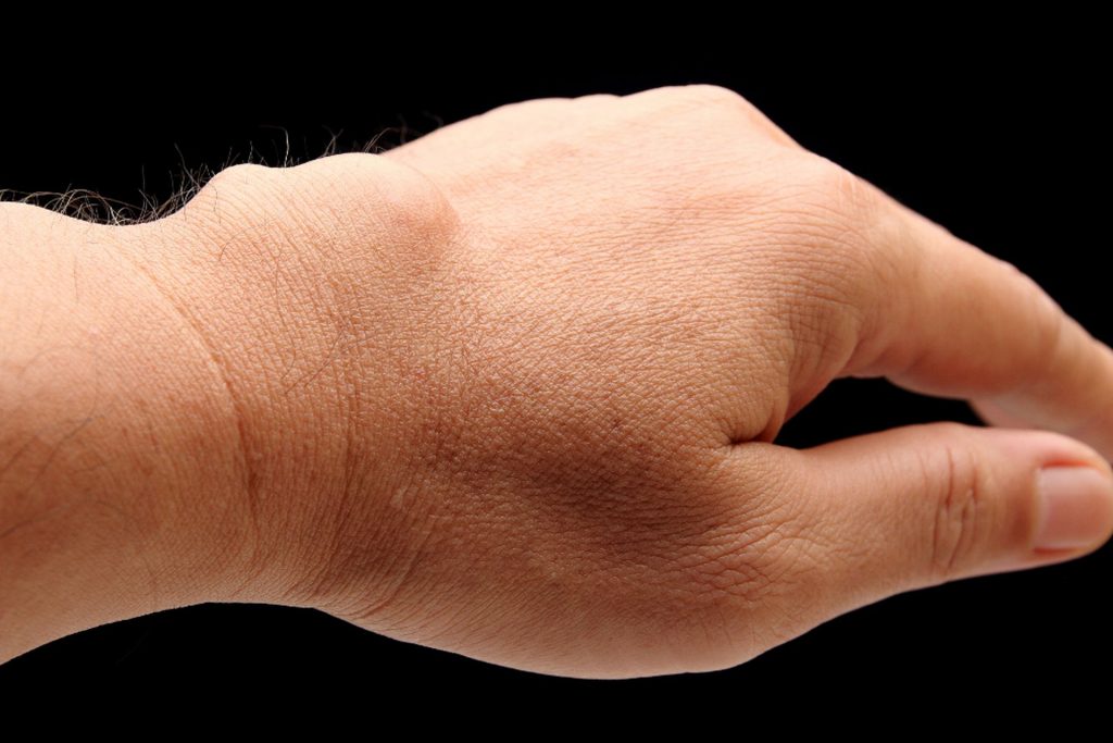 Ganglion - Ordination Dr. Url