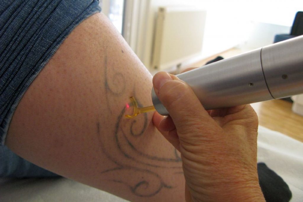 Entfernen von Tätowierungen