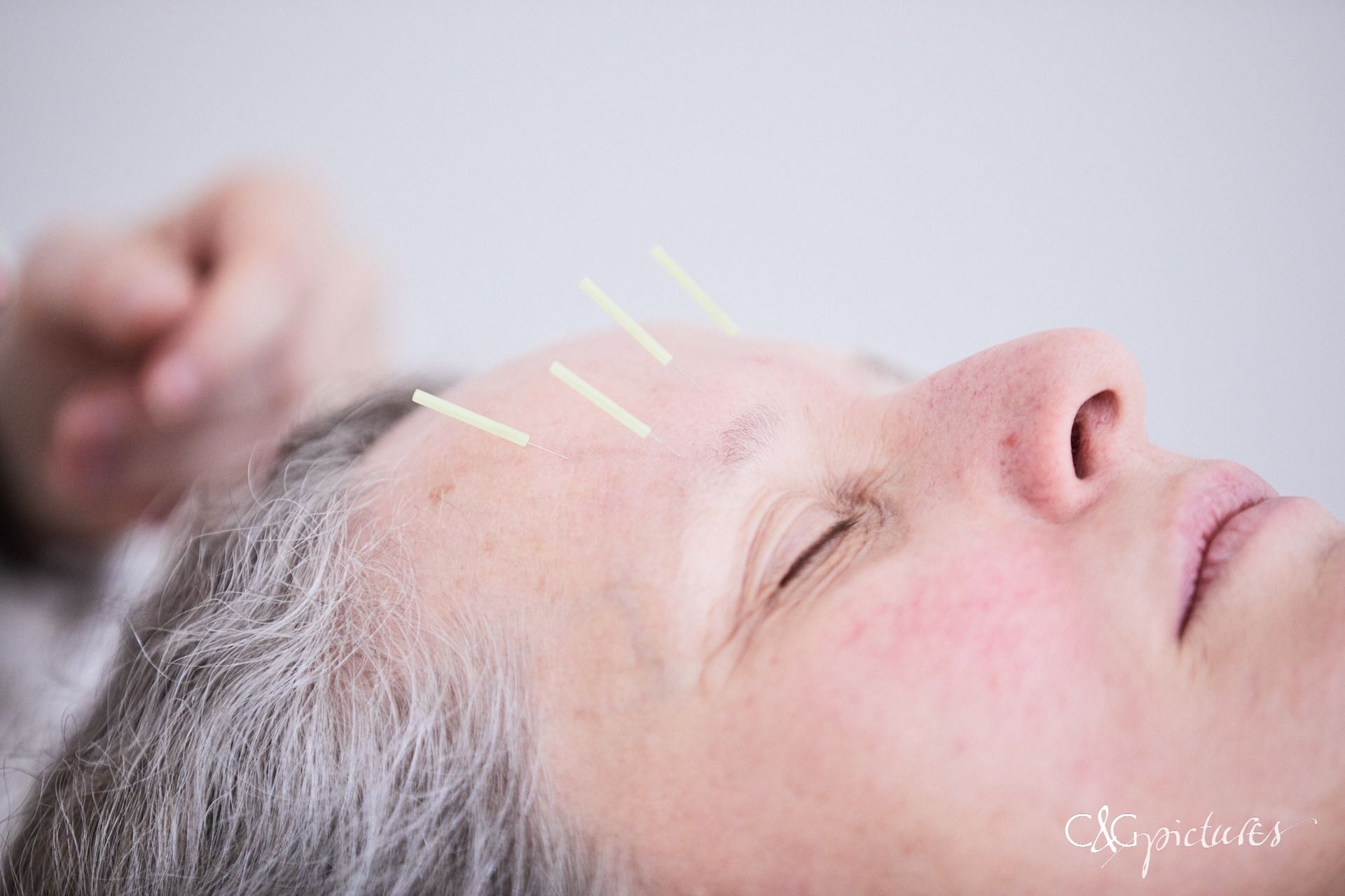 Stess Akupunktur