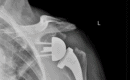 Röntgenaufnahme Schultergelenk Prothese