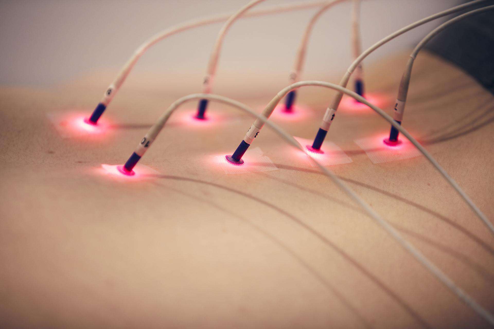 Laserneedle Behandlung - Rücken mit Lasernadeln